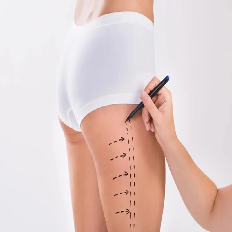 Inner-thigh-lifting
