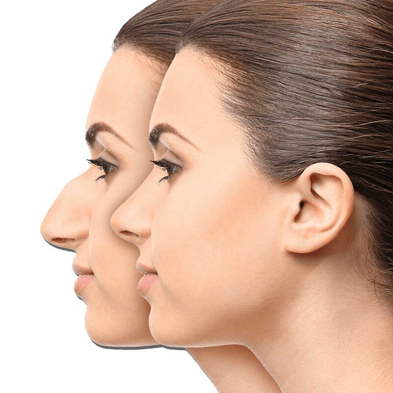 Rhinoplasty (1)